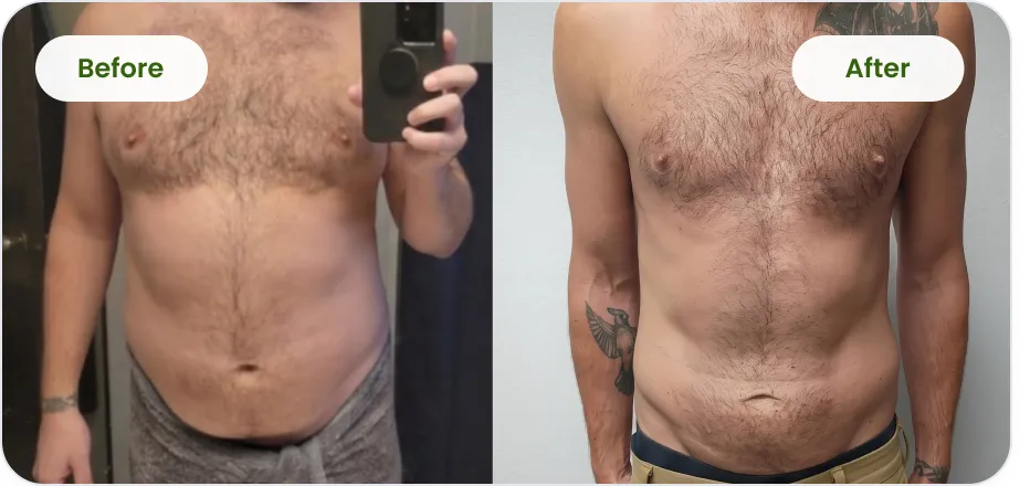 Patient before and after medical weight loss, front view