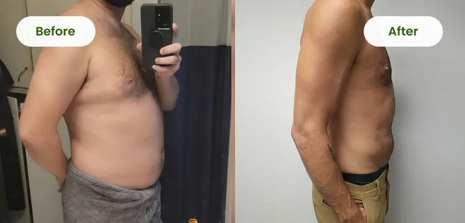 Patient before and after medical weight loss, side view