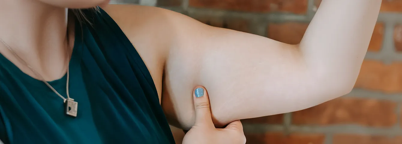 Woman pinching the back of her upper arm